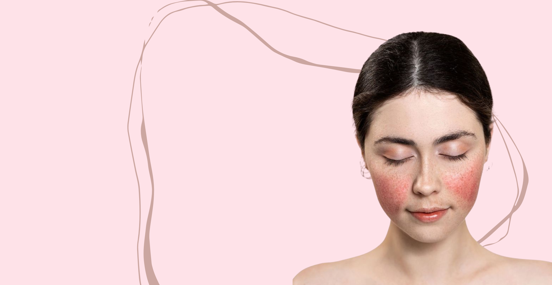 Rosacea a korejska kozmetika (blog cover)